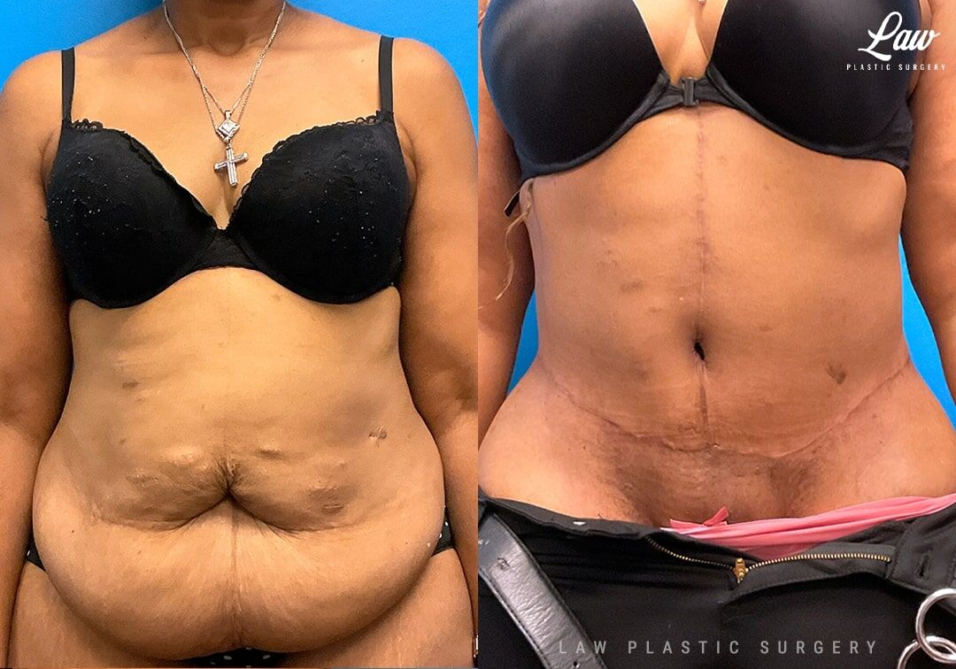 Tummy Tuck Austin