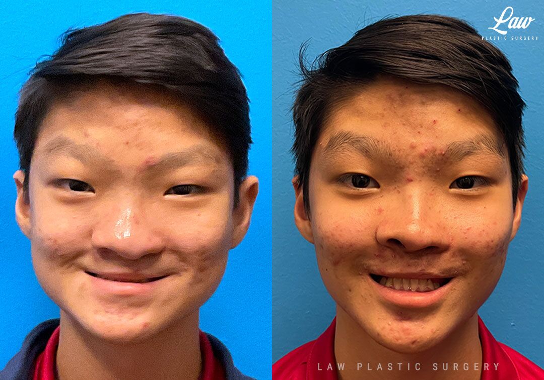 Asian Rhinoplasty Before After Photos Law Plastic Surgery