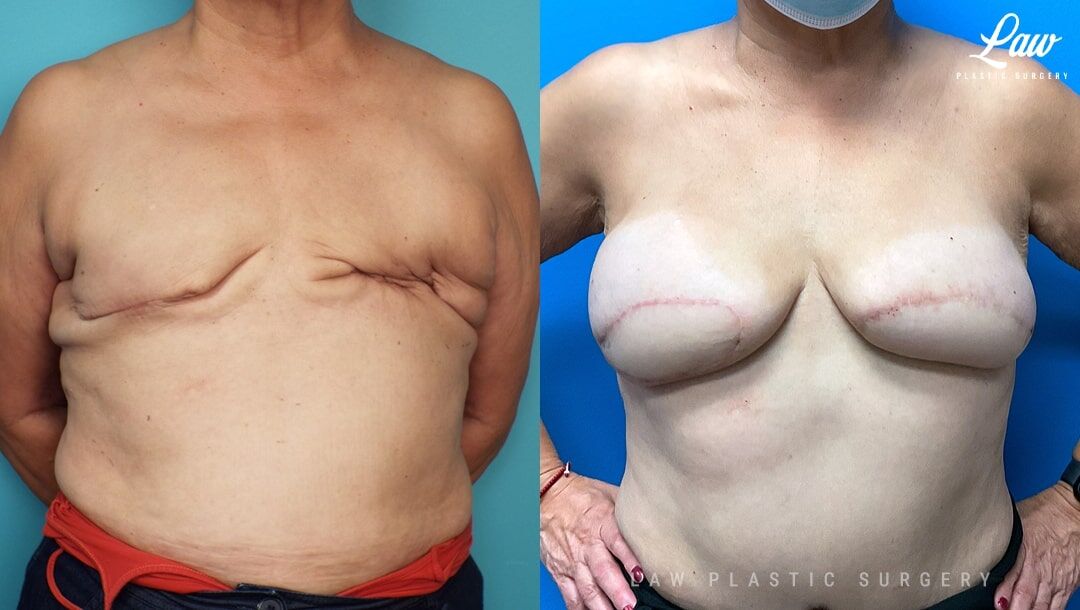 double mastectomy plastic surgery Breast Reconstruction Before & After Photos - Law Plastic Surgery