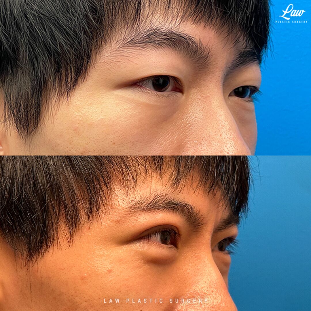 Japanese eyelid surgery before and after discount