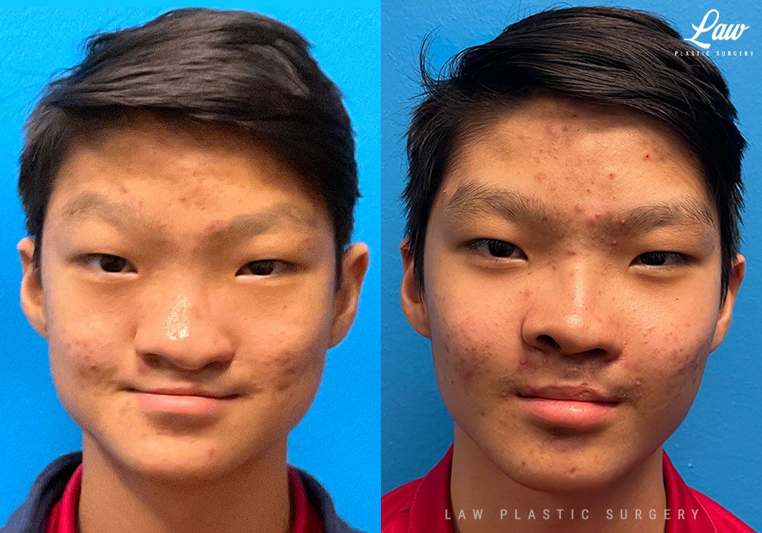 Cleft Rhinoplasty Before & After Photos - Law Plastic Surgery