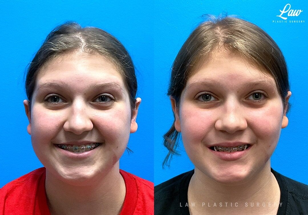 Jaw Surgery Before & After Photos - Law Plastic Surgery