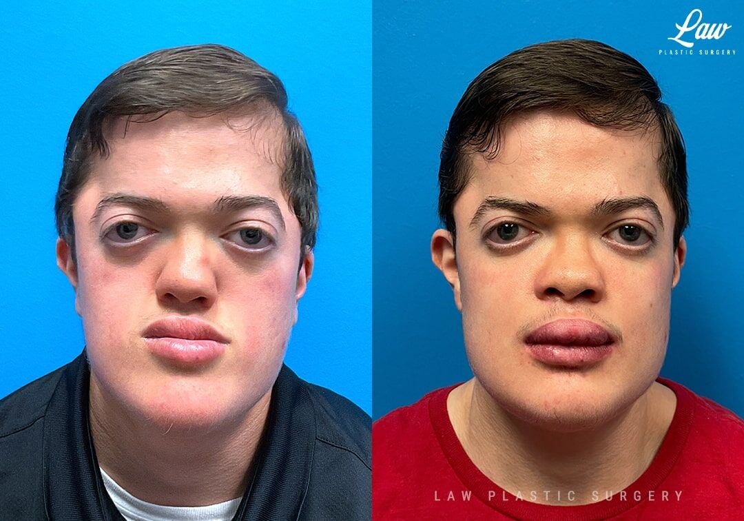 jaw removal