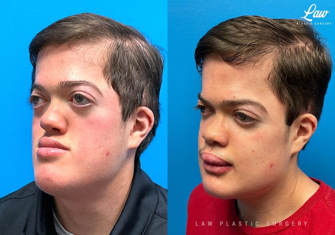 jaw removal