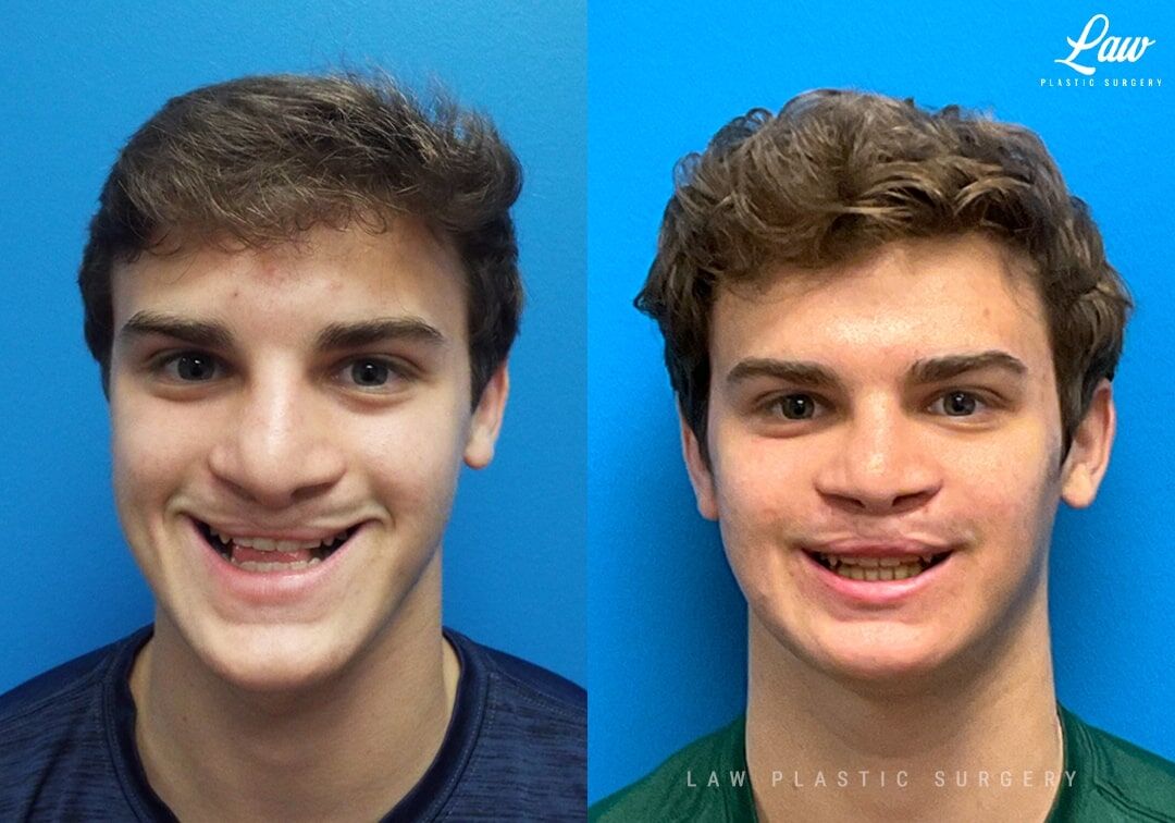 Jaw before and after: fotos e imagens