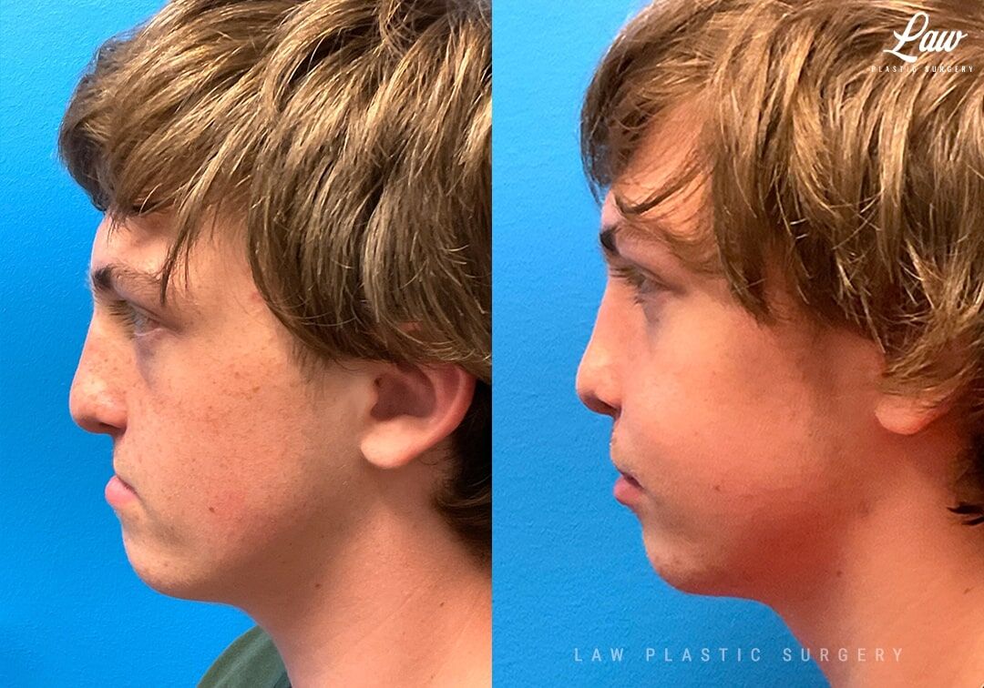 Jaw Surgery Before & After Photos - Law Plastic Surgery