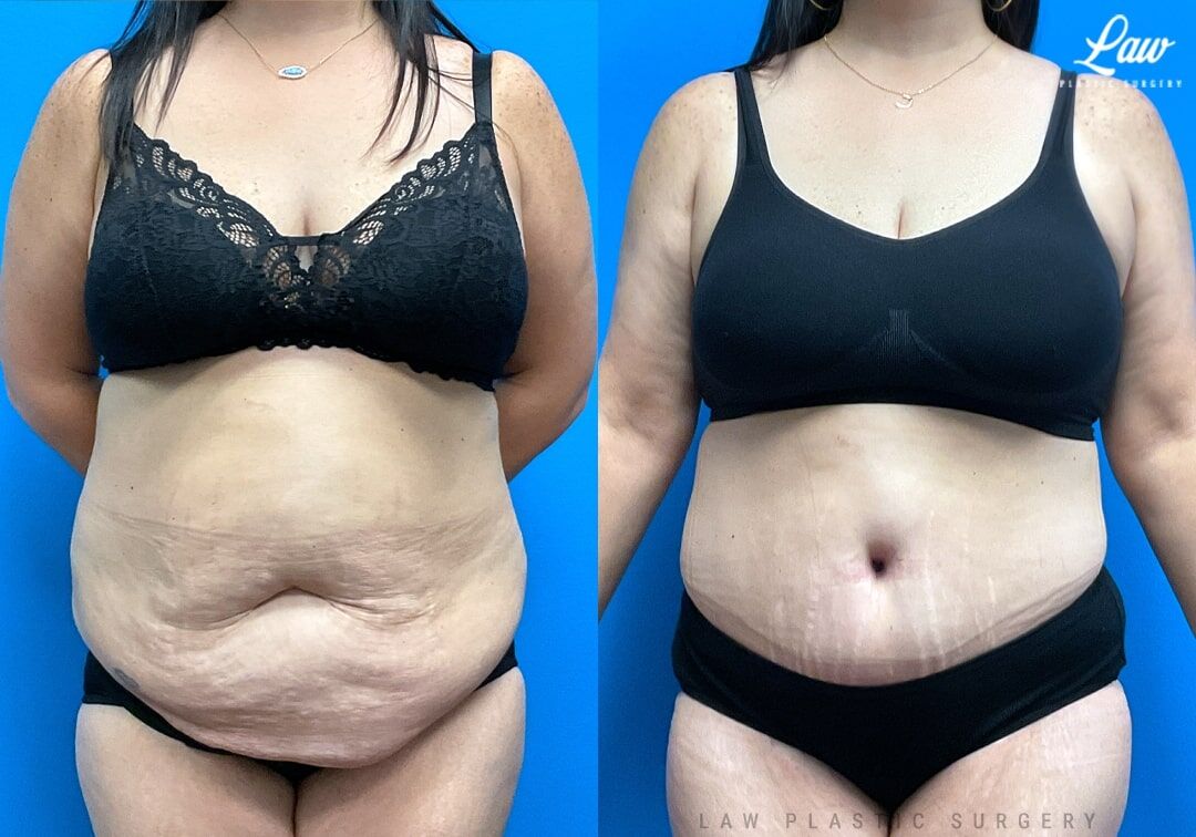Tummy Tuck Before & After Photos - Law Plastic Surgery