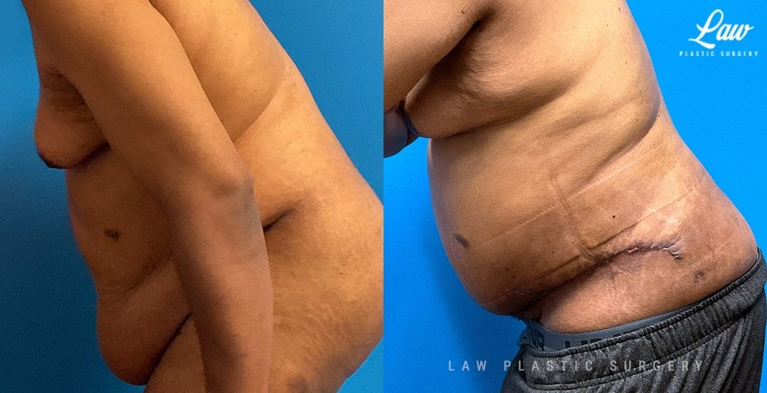 Tummy Tuck Scars Over Time with Pictures and posted Jan 26, 2024