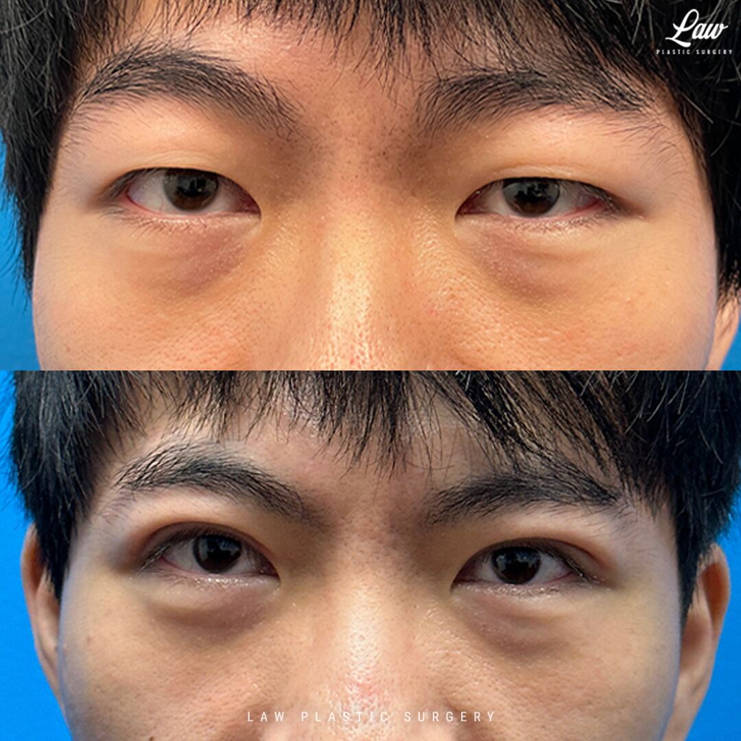 Asian Eyelid Surgery Before After 2a 